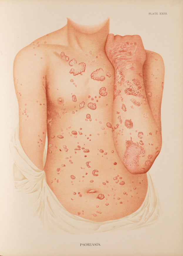 Ein Buchumschlag mit einer Illustration eines Männerkörpers mit roten Flecken, die wahrscheinlich auf Psoriasis hinweisen, zusammen mit Text zum Thema.